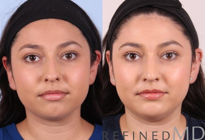 Before & After Rhinoplasty Case 1125 View 1 View in Los Gatos & San Jose, CA