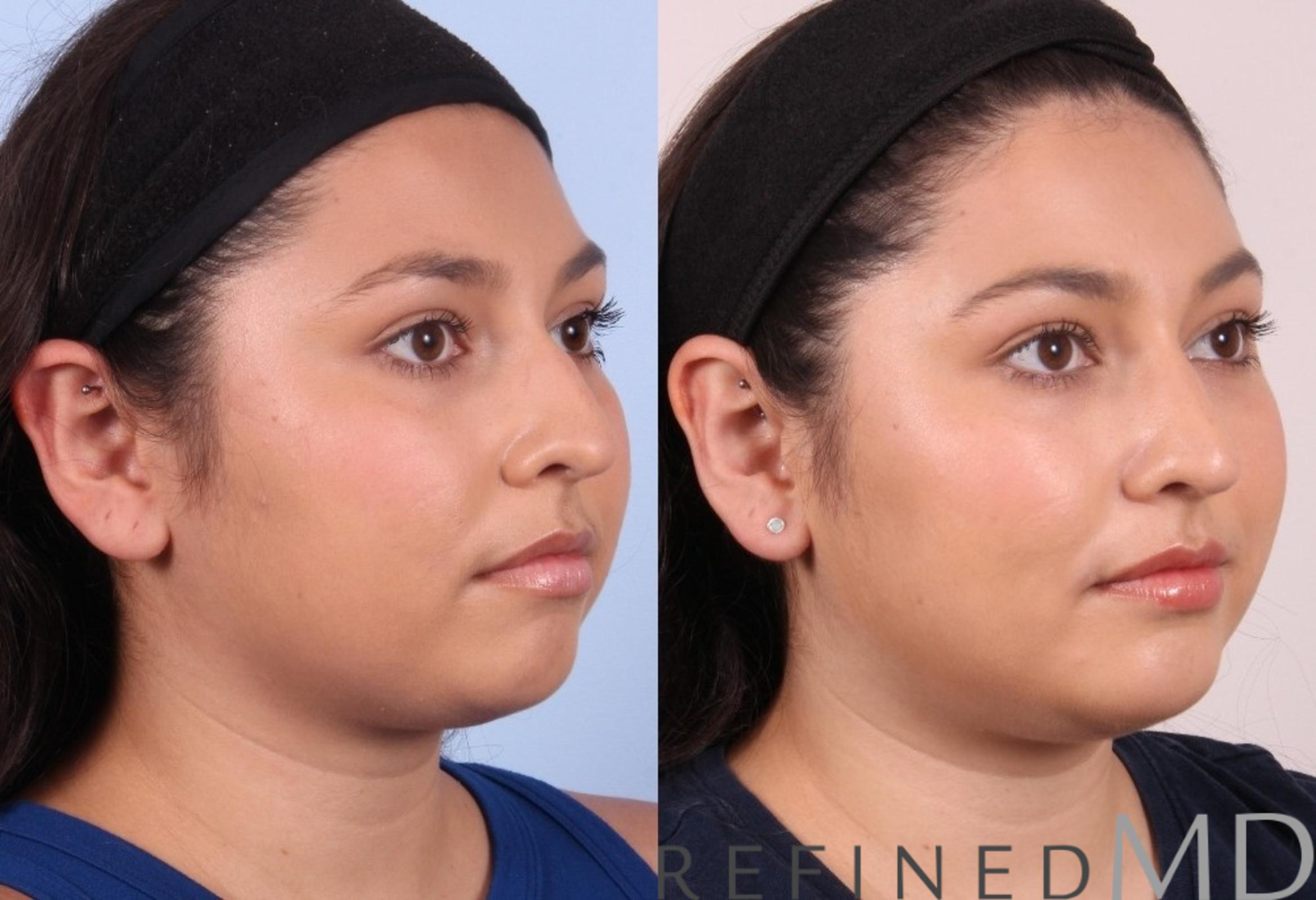 Before & After Rhinoplasty Case 1125 View 2 View in Los Gatos & San Jose, CA