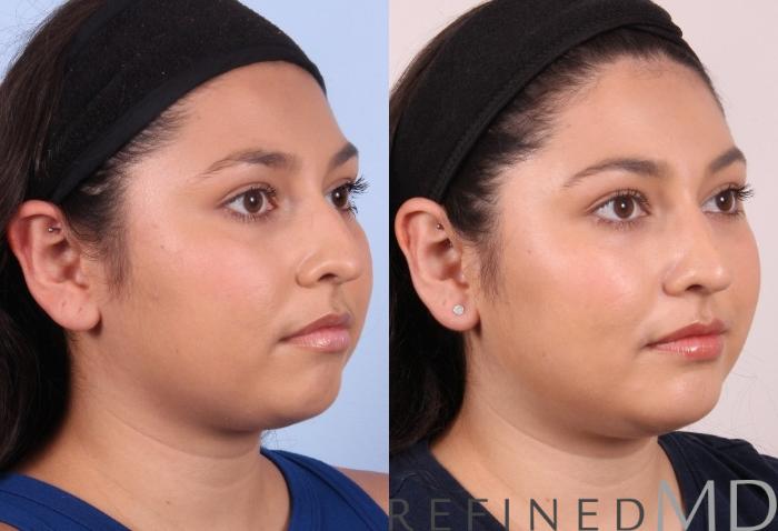 Before & After Rhinoplasty Case 1125 View 2 View in Los Gatos & San Jose, CA
