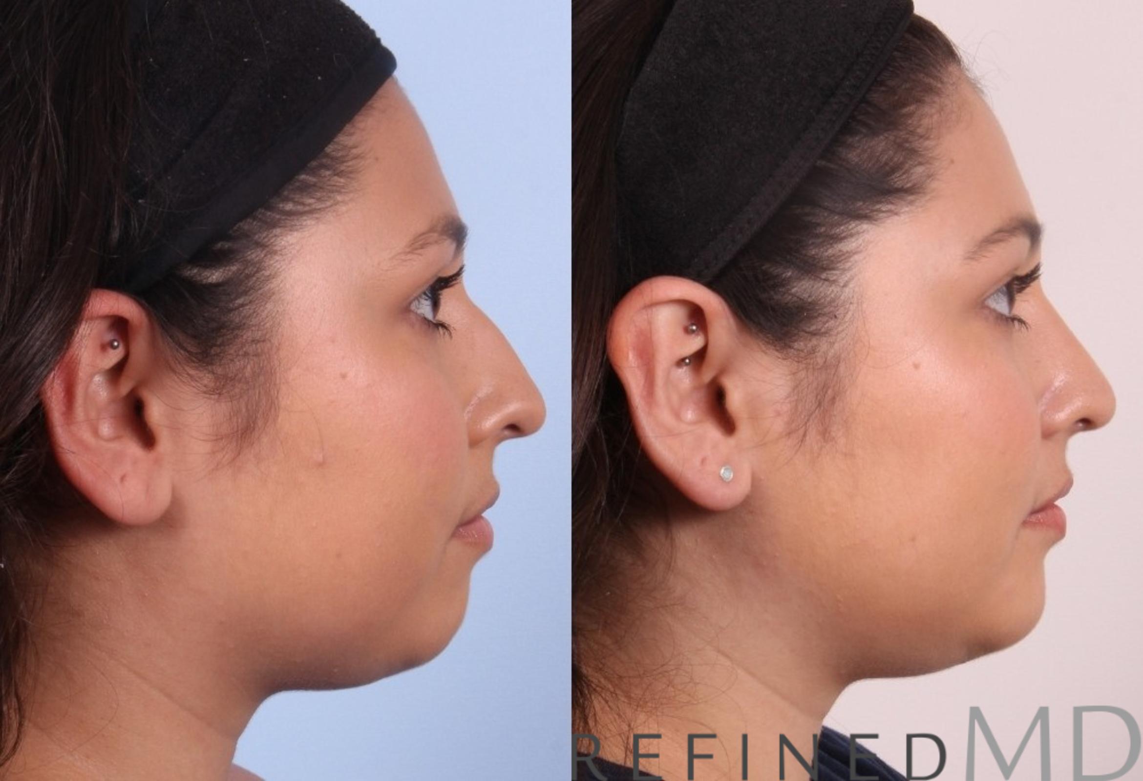 Before & After Rhinoplasty Case 1125 View 3 View in Los Gatos & San Jose, CA