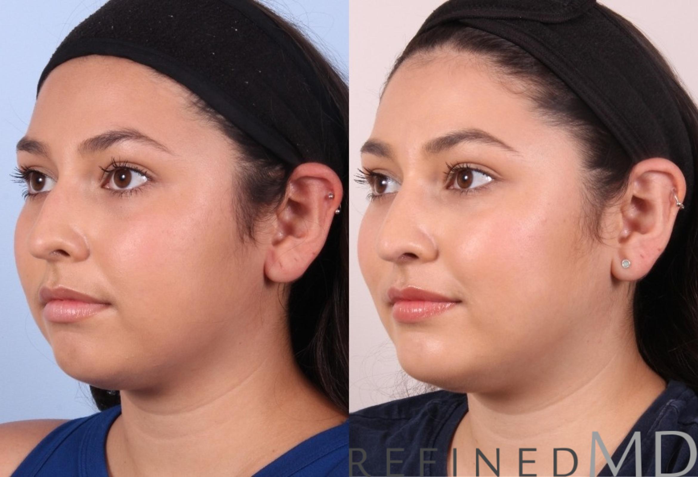 Before & After Rhinoplasty Case 1125 View 4 View in Los Gatos & San Jose, CA