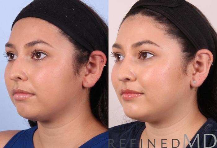 Before & After Rhinoplasty Case 1125 View 4 View in Los Gatos & San Jose, CA