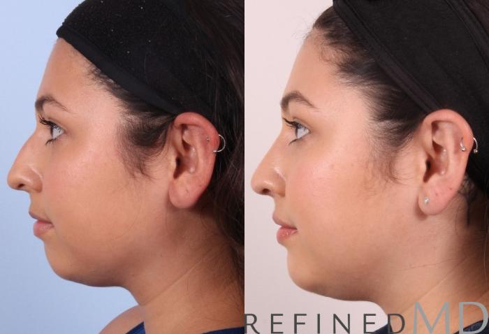 Before & After Rhinoplasty Case 1125 View 5 View in Los Gatos & San Jose, CA