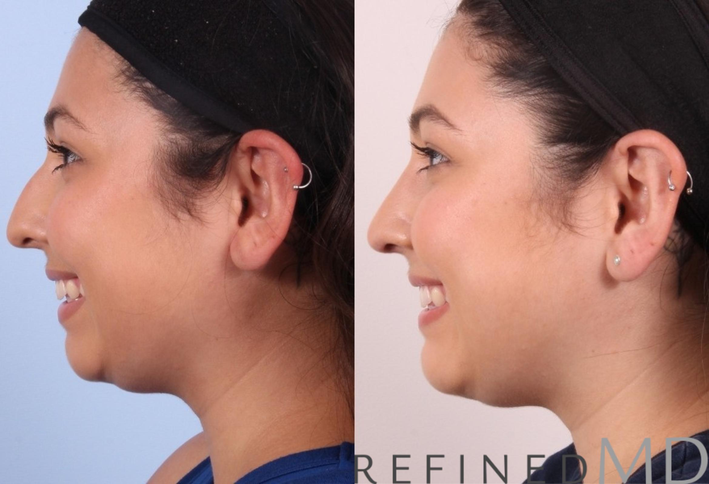 Before & After Rhinoplasty Case 1125 View 6 View in Los Gatos & San Jose, CA