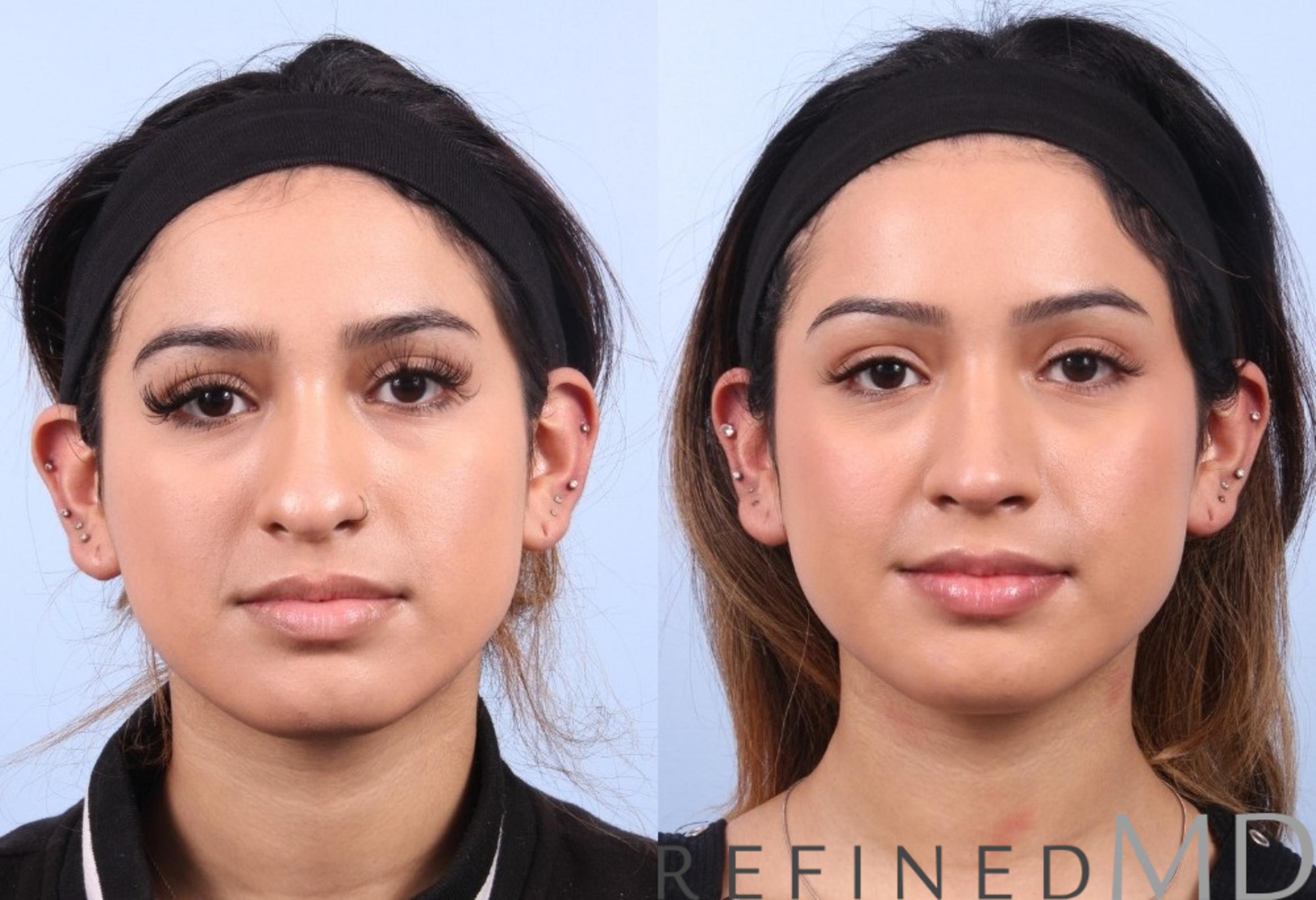 Before & After Rhinoplasty Case 1126 View 1 View in Los Gatos & San Jose, CA