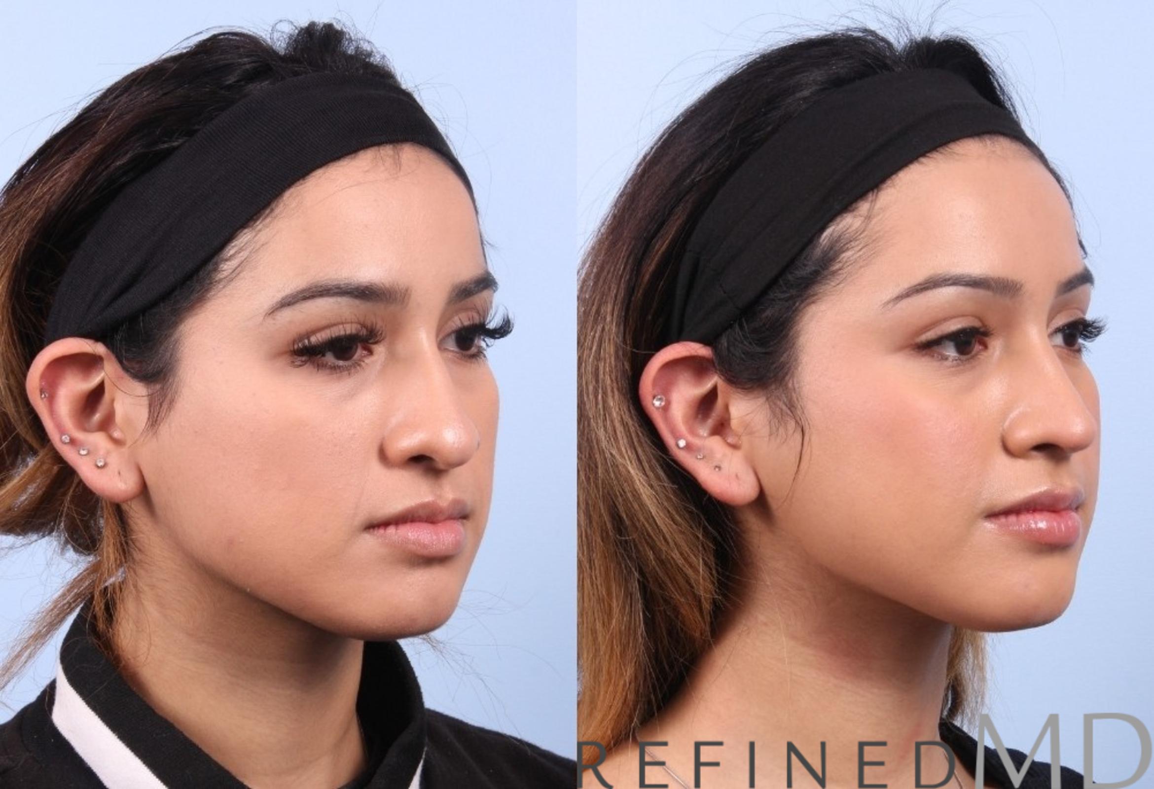 Before & After Rhinoplasty Case 1126 View 2 View in Los Gatos & San Jose, CA