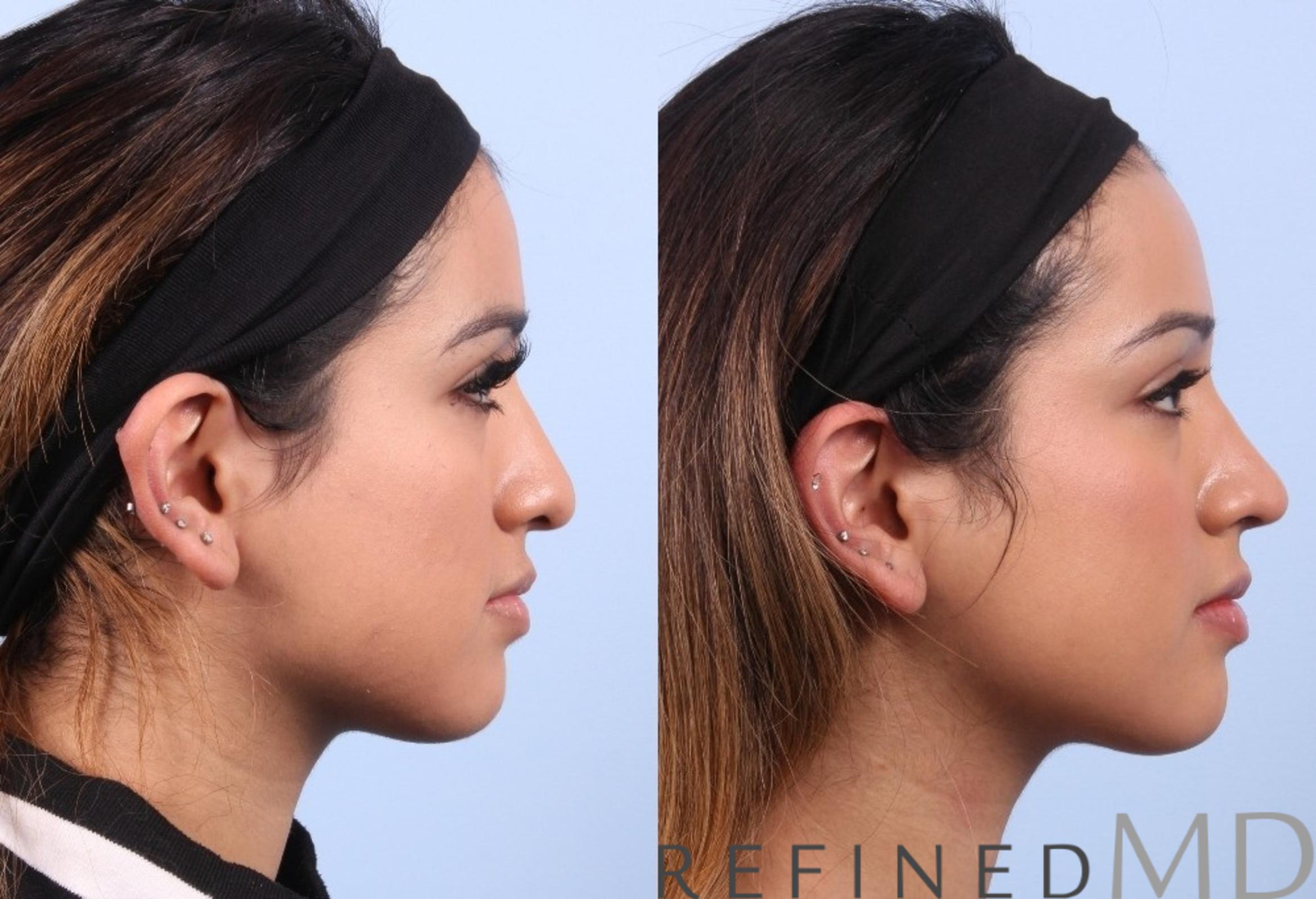 Before & After Rhinoplasty Case 1126 View 3 View in Los Gatos & San Jose, CA