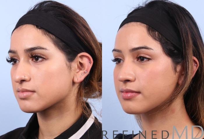 Before & After Rhinoplasty Case 1126 View 4 View in Los Gatos & San Jose, CA