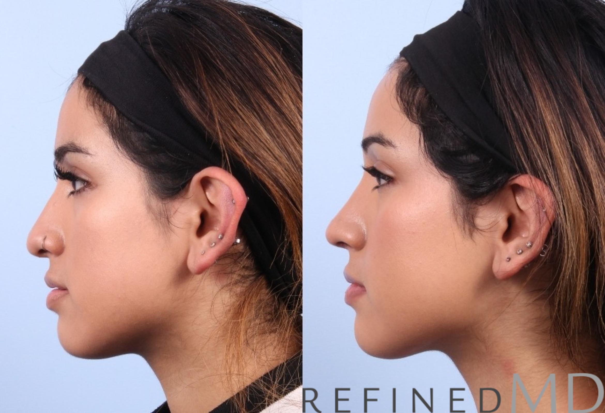 Before & After Rhinoplasty Case 1126 View 5 View in Los Gatos & San Jose, CA
