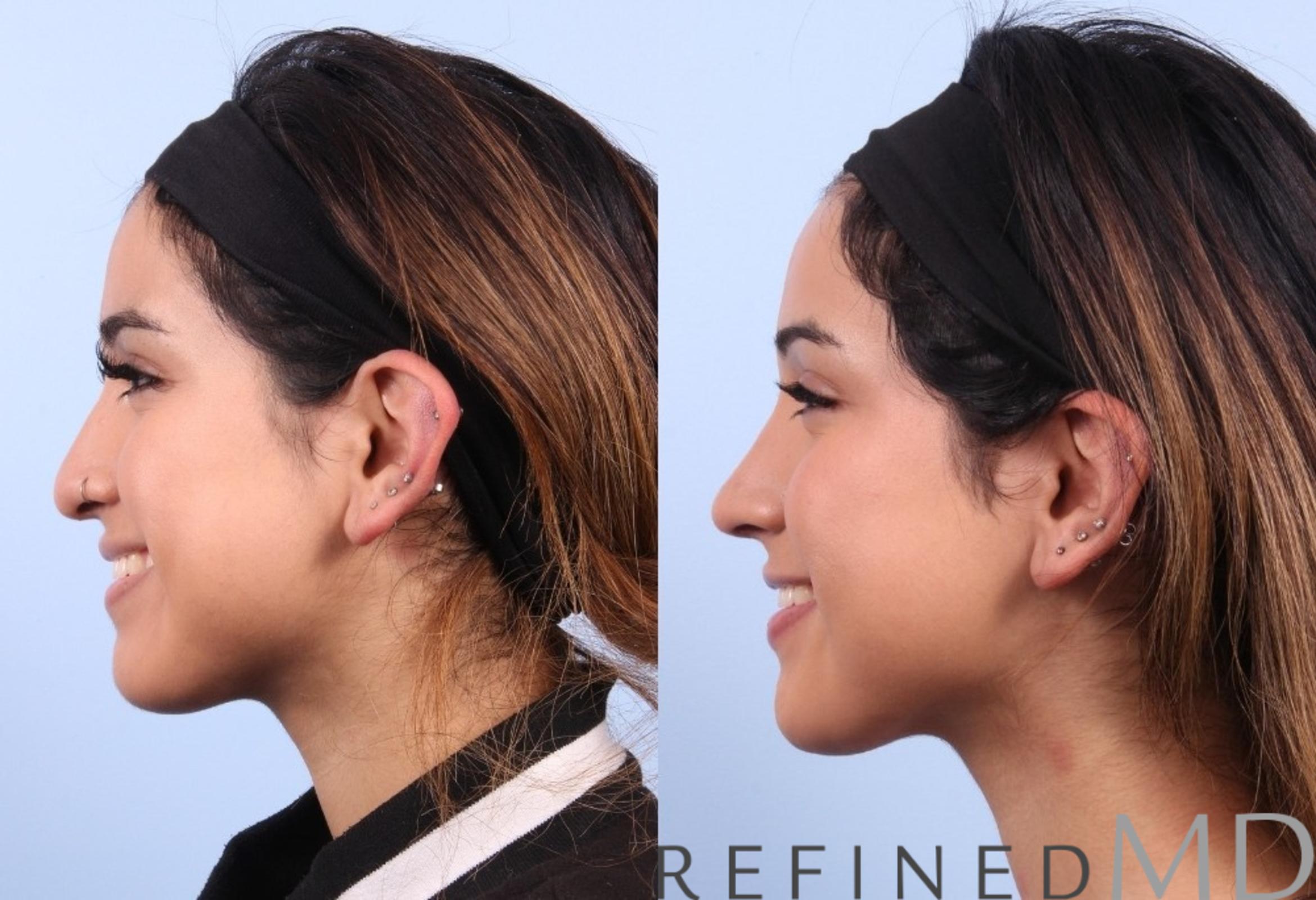 Before & After Rhinoplasty Case 1126 View 6 View in Los Gatos & San Jose, CA