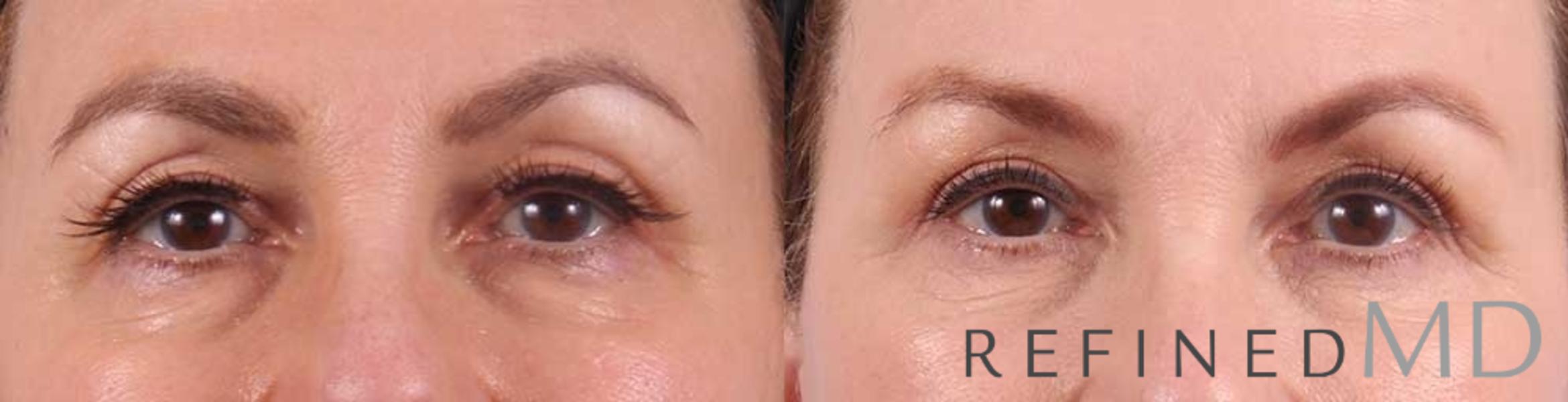 Before & After Upper Eyelid Case 1097 View 1 View in Los Gatos & San Jose, CA