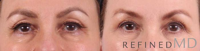 Before & After Upper Eyelid Case 1097 View 1 View in Los Gatos & San Jose, CA