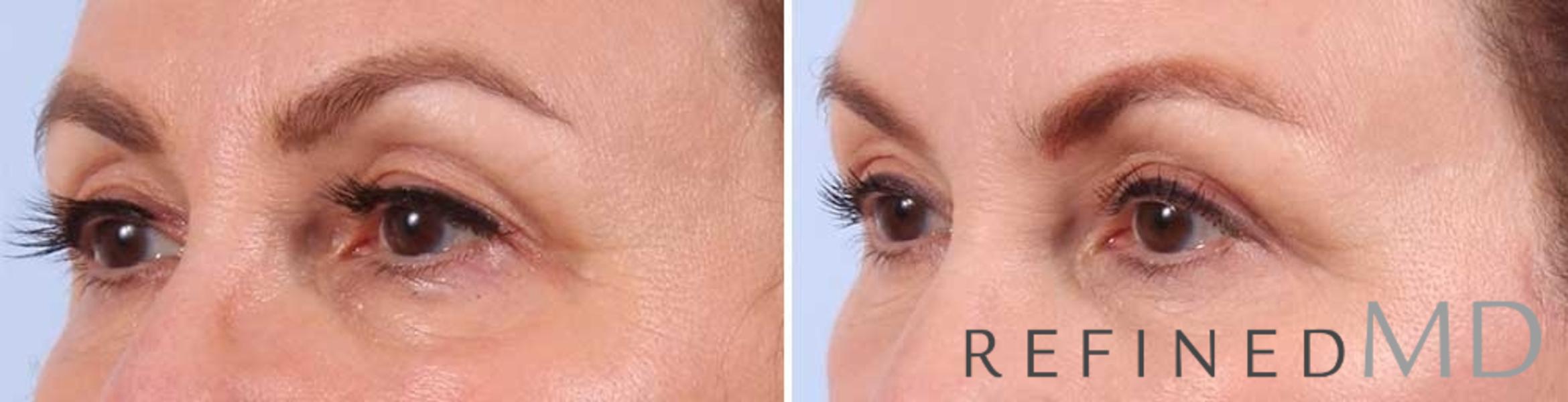 Before & After Upper Eyelid Case 1097 View 2 View in Los Gatos & San Jose, CA