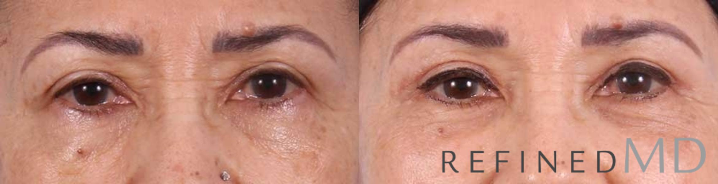 Before & After Upper Eyelid Case 1098 View 1 View in Los Gatos & San Jose, CA