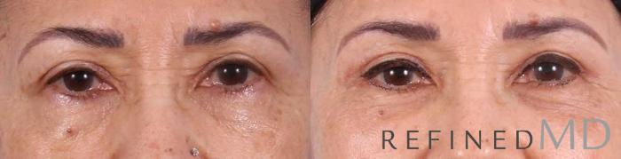 Before & After Upper Eyelid Case 1098 View 1 View in Los Gatos & San Jose, CA
