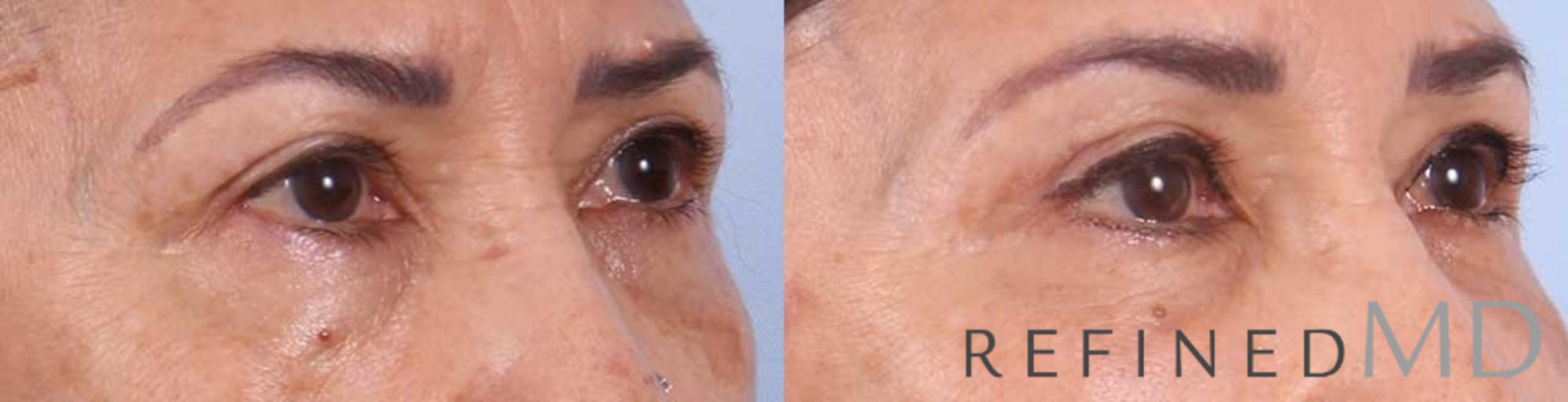 Before & After Upper Eyelid Case 1098 View 2 View in Los Gatos & San Jose, CA
