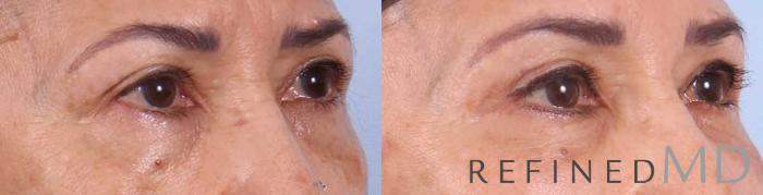 Before & After Upper Eyelid Case 1098 View 2 View in Los Gatos & San Jose, CA