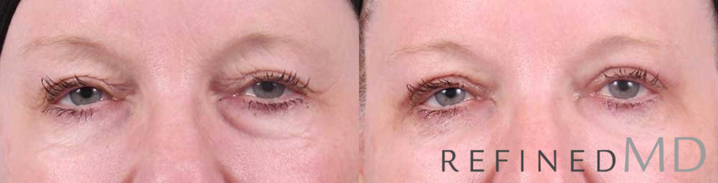 Before & After Upper Eyelid Case 1099 View 1 View in Los Gatos & San Jose, CA