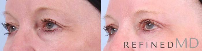 Before & After Upper Eyelid Case 1099 View 2 View in Los Gatos & San Jose, CA