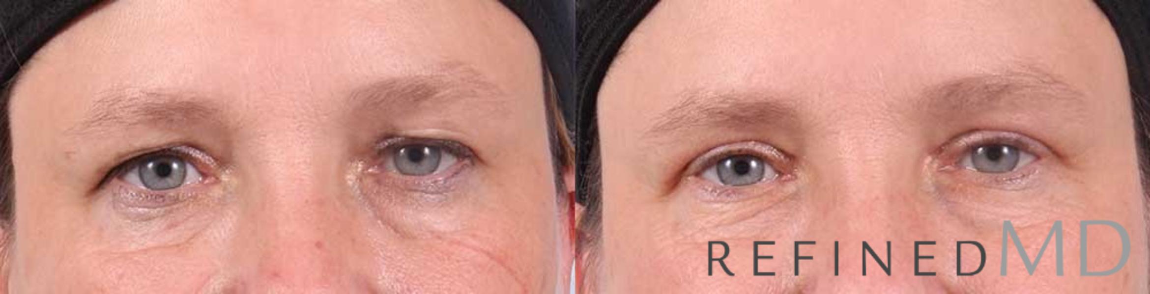 Before & After Upper Eyelid Case 1100 View 1 View in Los Gatos & San Jose, CA