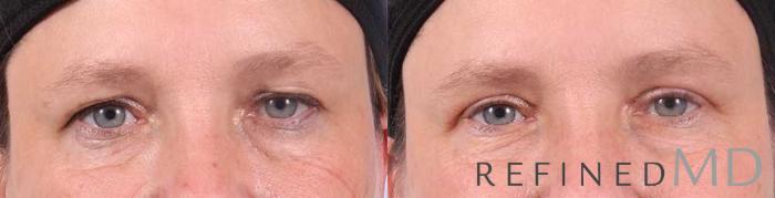 Before & After Upper Eyelid Case 1100 View 1 View in Los Gatos & San Jose, CA