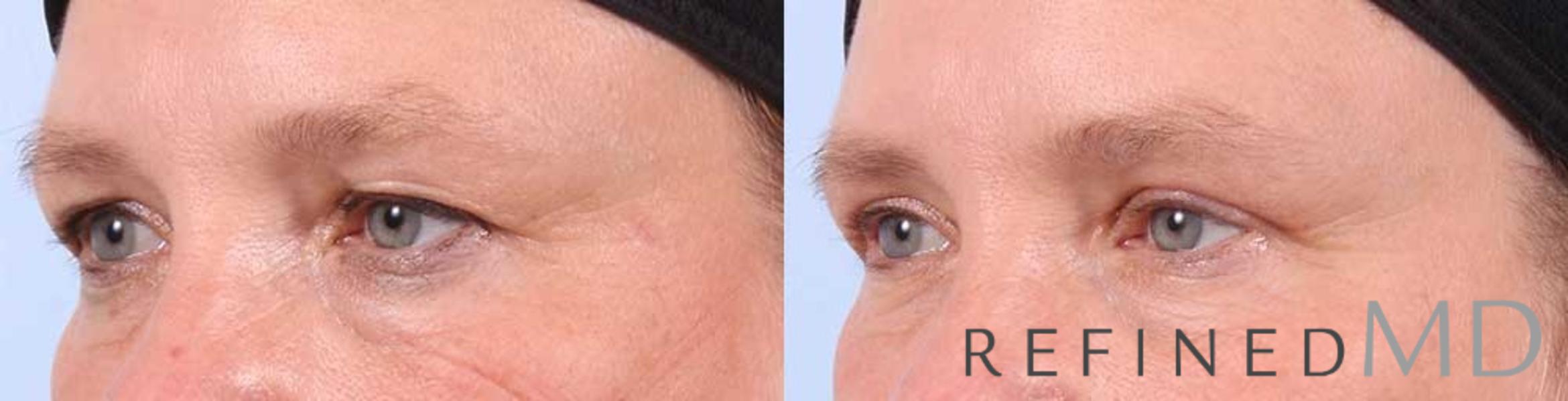 Before & After Upper Eyelid Case 1100 View 2 View in Los Gatos & San Jose, CA