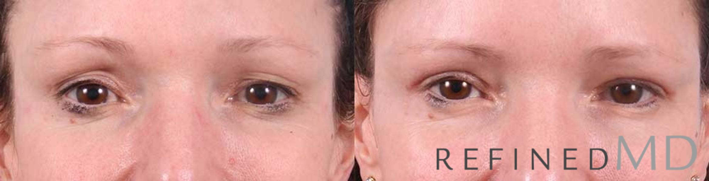 Before & After Upper Eyelid Case 1101 View 1 View in Los Gatos & San Jose, CA