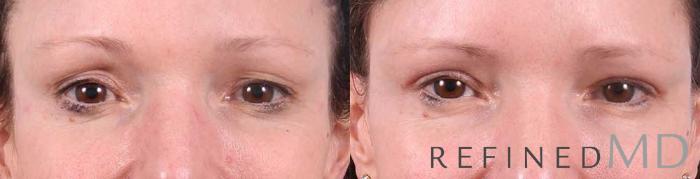 Before & After Upper Eyelid Case 1101 View 1 View in Los Gatos & San Jose, CA