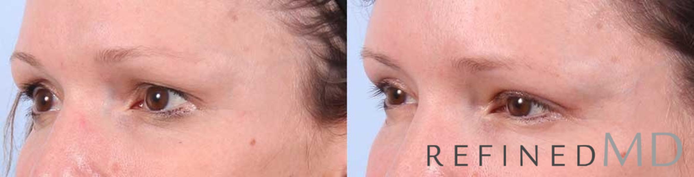 Before & After Upper Eyelid Case 1101 View 2 View in Los Gatos & San Jose, CA