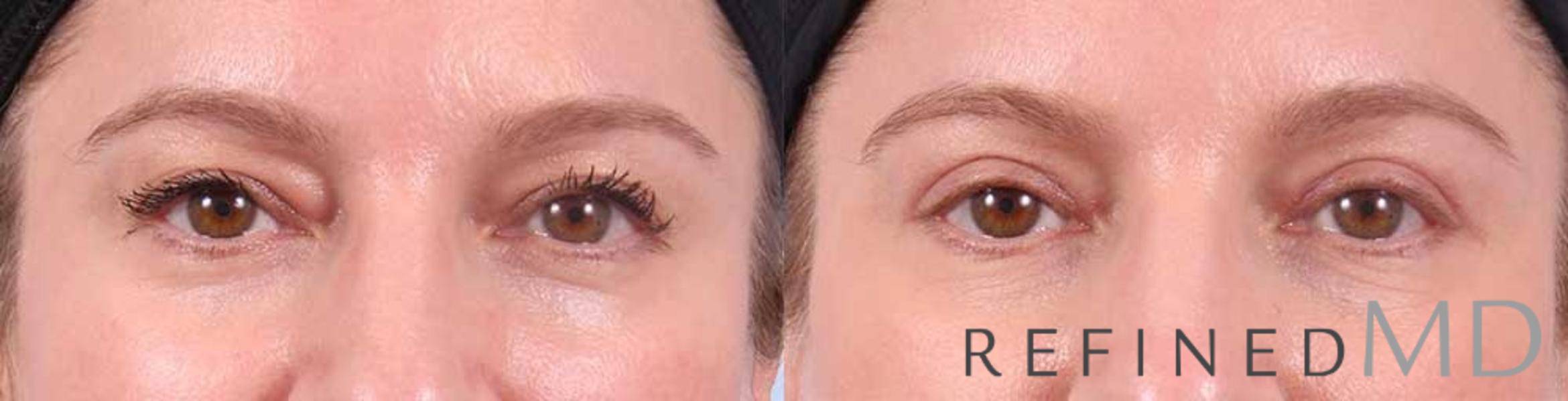 Before & After Upper Eyelid Case 1102 View 1 View in Los Gatos & San Jose, CA