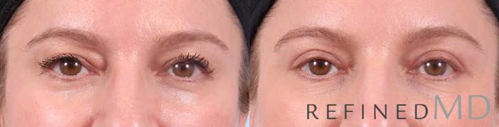 Before & After Upper Eyelid Case 1102 View 1 View in Los Gatos & San Jose, CA