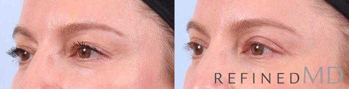 Before & After Upper Eyelid Case 1102 View 2 View in Los Gatos & San Jose, CA