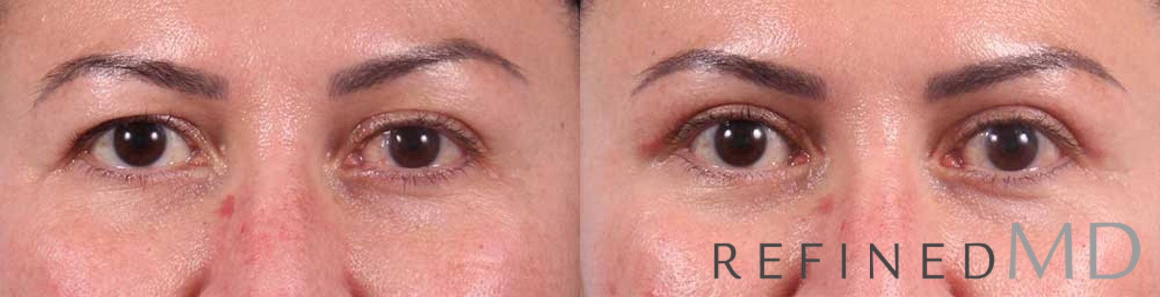 Before & After Upper Eyelid Case 1103 View 1 View in Los Gatos & San Jose, CA