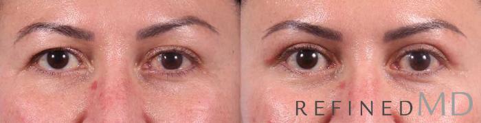 Before & After Upper Eyelid Case 1103 View 1 View in Los Gatos & San Jose, CA