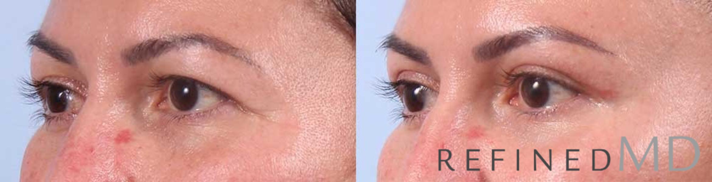 Before & After Upper Eyelid Case 1103 View 2 View in Los Gatos & San Jose, CA