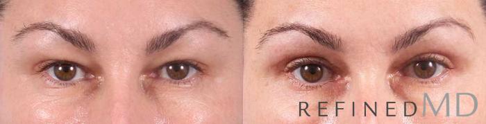 Before & After Upper Eyelid Case 1104 View 1 View in Los Gatos & San Jose, CA
