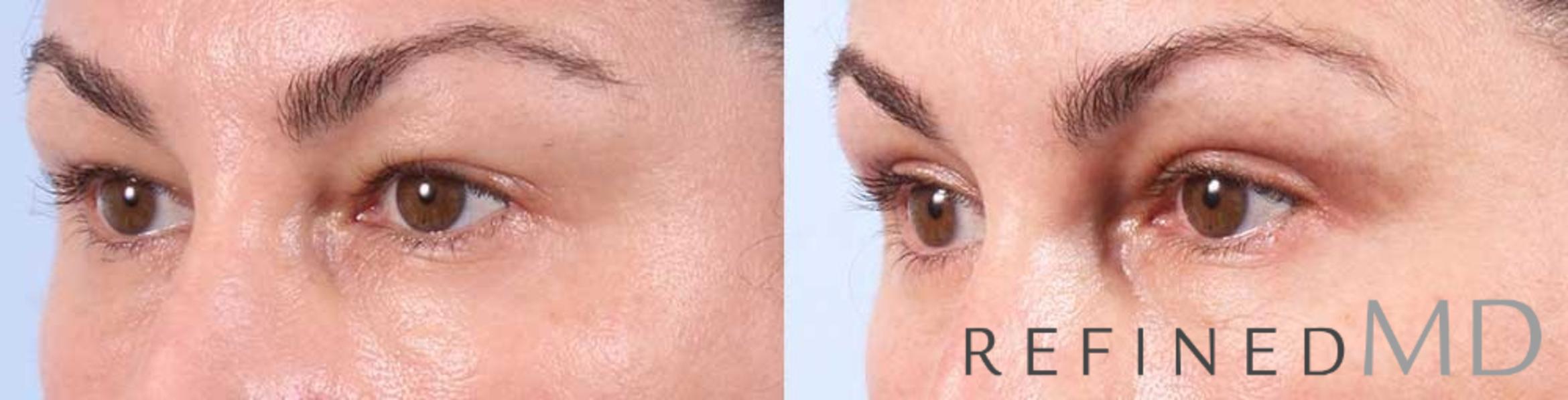 Before & After Upper Eyelid Case 1104 View 2 View in Los Gatos & San Jose, CA