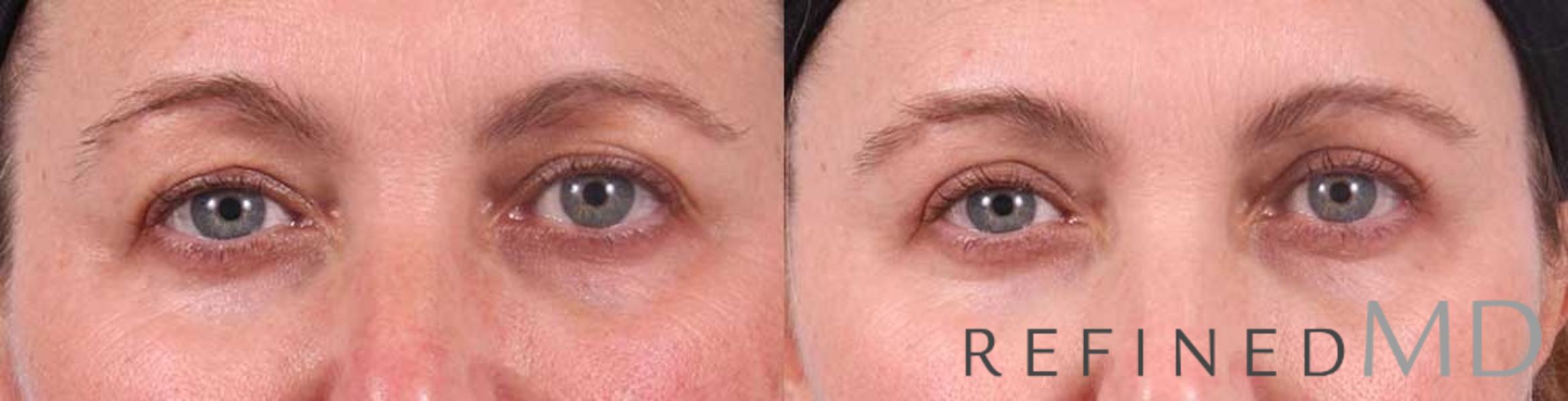 Before & After Upper Eyelid Case 1105 View 1 View in Los Gatos & San Jose, CA