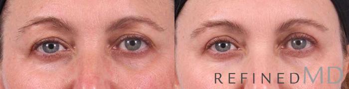 Before & After Upper Eyelid Case 1105 View 1 View in Los Gatos & San Jose, CA