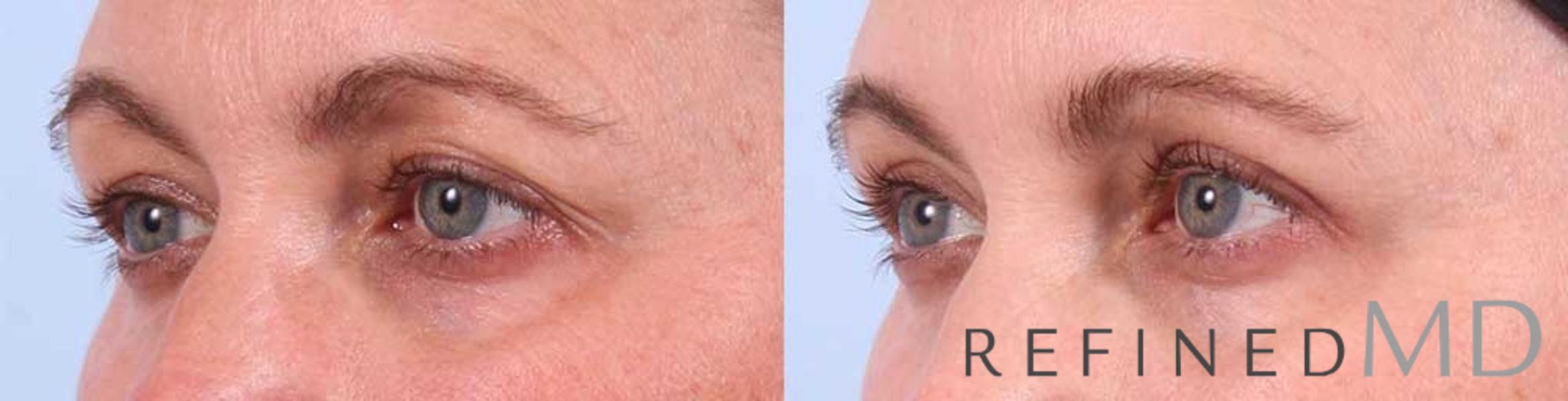 Before & After Upper Eyelid Case 1105 View 2 View in Los Gatos & San Jose, CA