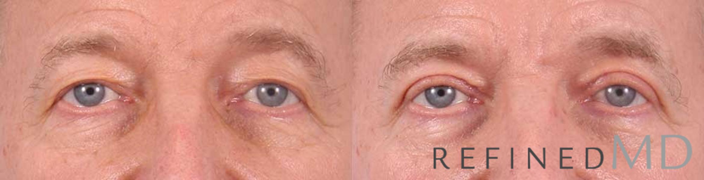 Before & After Upper Eyelid Case 1106 View 1 View in Los Gatos & San Jose, CA