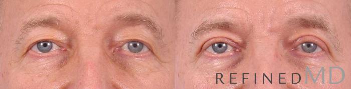 Before & After Upper Eyelid Case 1106 View 1 View in Los Gatos & San Jose, CA