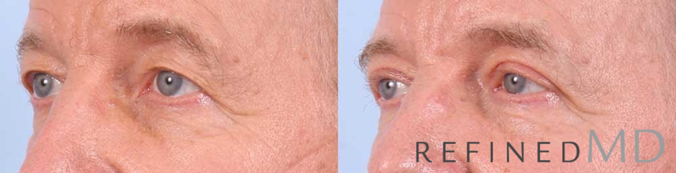 Before & After Upper Eyelid Case 1106 View 2 View in Los Gatos & San Jose, CA
