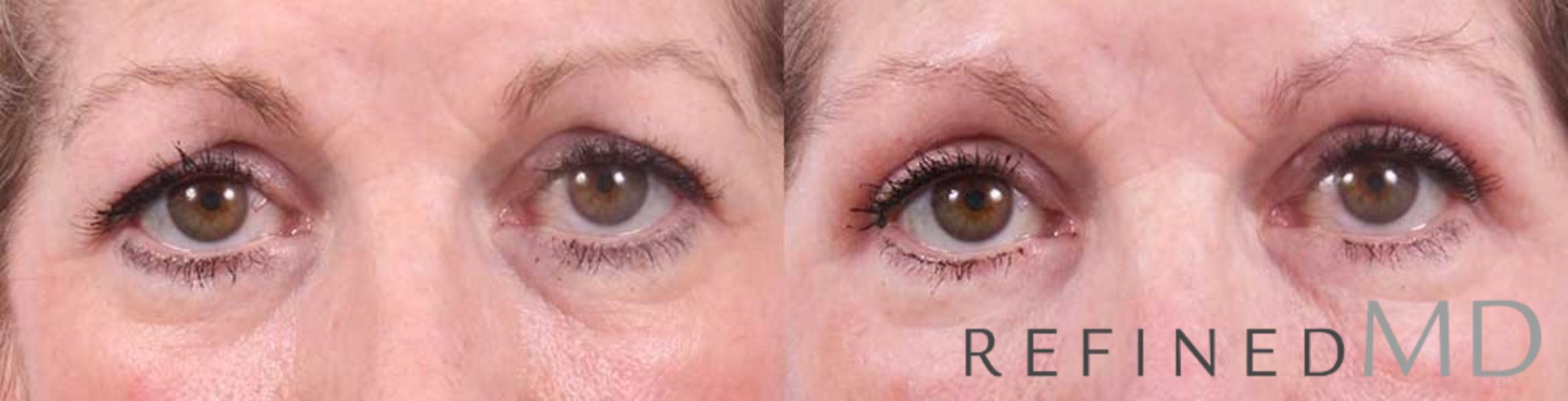 Before & After Upper Eyelid Case 1107 View 1 View in Los Gatos & San Jose, CA