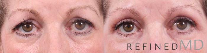 Before & After Upper Eyelid Case 1107 View 1 View in Los Gatos & San Jose, CA