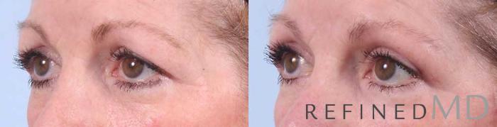 Before & After Upper Eyelid Case 1107 View 2 View in Los Gatos & San Jose, CA