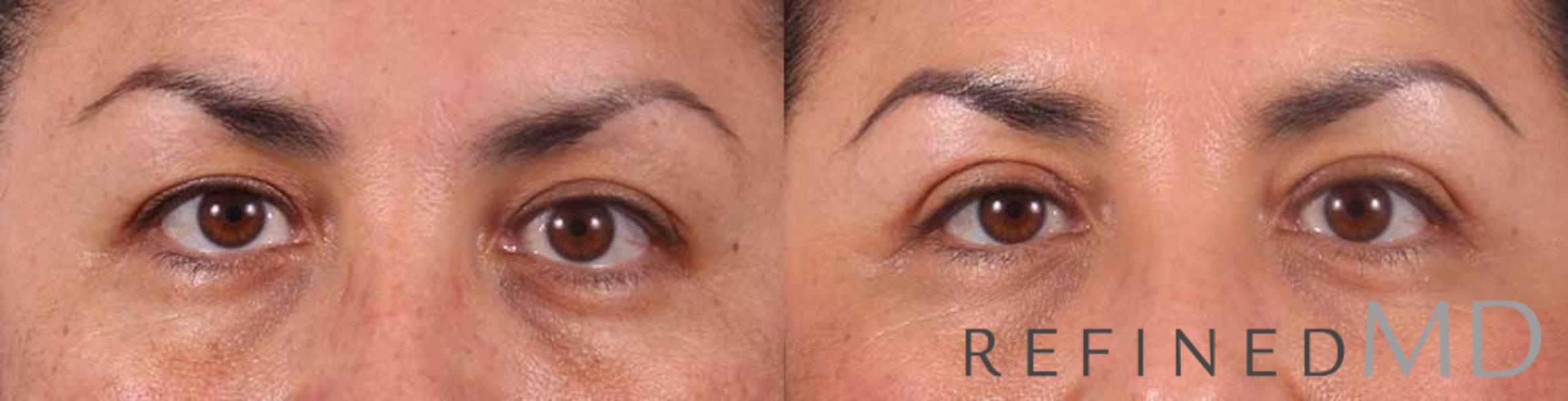Before & After Upper Eyelid Case 1108 View 1 View in Los Gatos & San Jose, CA