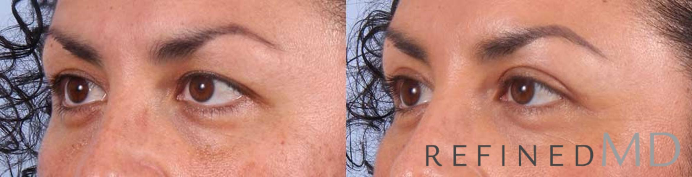 Before & After Upper Eyelid Case 1108 View 2 View in Los Gatos & San Jose, CA
