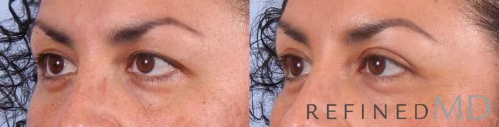 Before & After Upper Eyelid Case 1108 View 2 View in Los Gatos & San Jose, CA