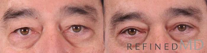 Before & After Upper Eyelid Case 1109 View 1 View in Los Gatos & San Jose, CA